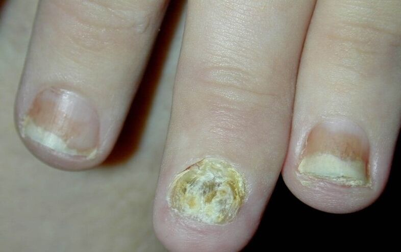 fingernail psoriasis
