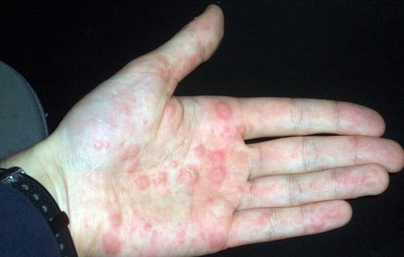 plaque psoriasis on the hands