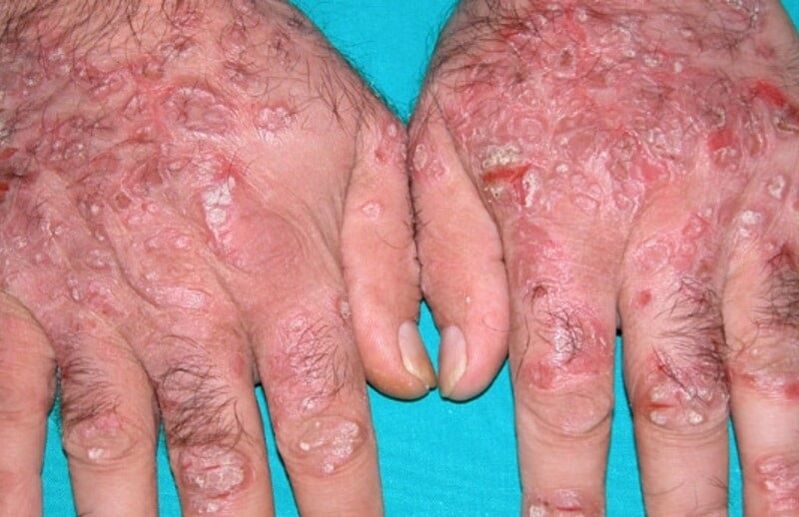 psoriasis drops on the hands