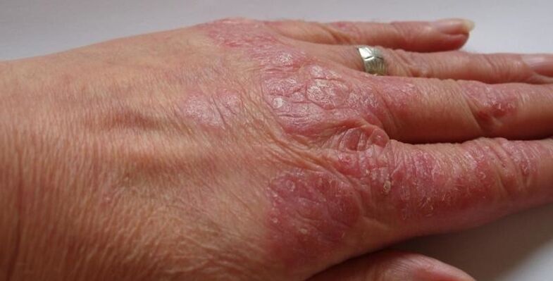 psoriasis on the hands