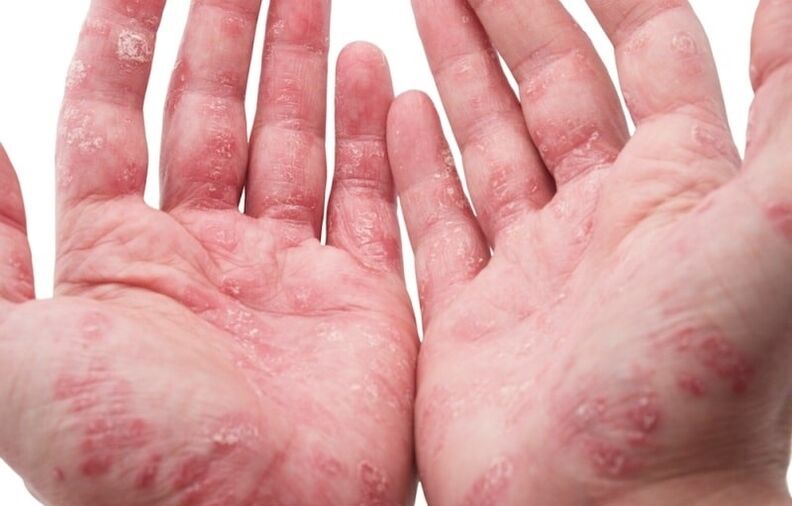 psoriasis on the palms of the hands
