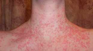 The stage and the symptoms of psoriasis