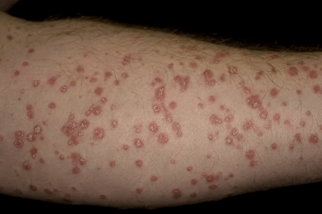 freckled psoriasis