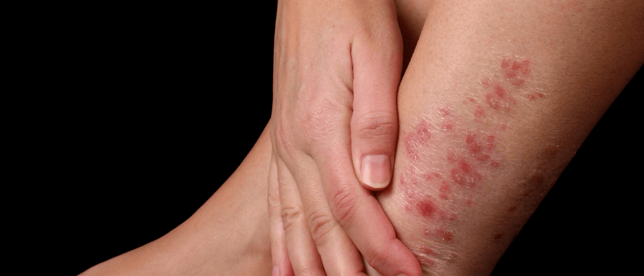 Psoriatic plaques on the skin of the feet