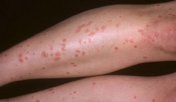 psoriasis drops on the legs