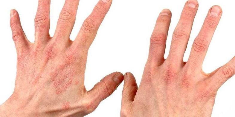 psoriasis on the hands how to treat folk remedies
