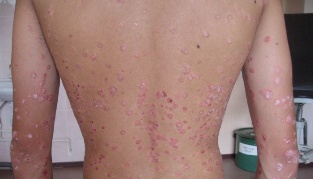 How to cure psoriasis quickly
