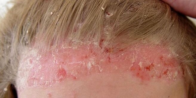 symptoms of psoriasis in the head