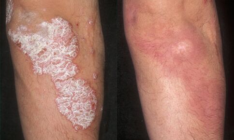 pictures before and after psoriasis treatment