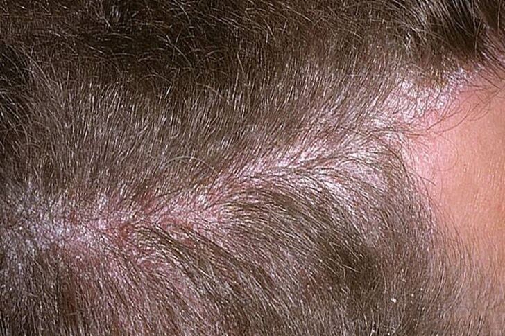 psoriasis on the head picture 3