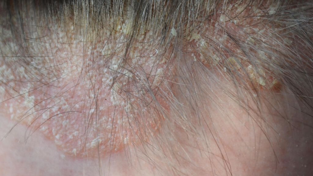psoriasis on the head picture 4