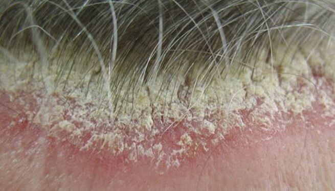 psoriasis on the head picture 5