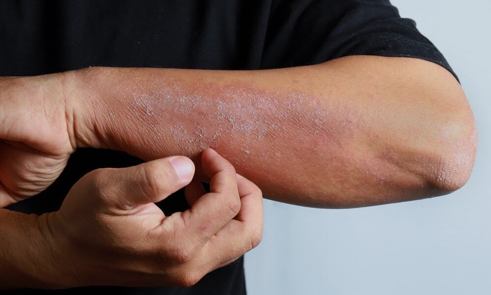 symptoms of psoriasis on the arm