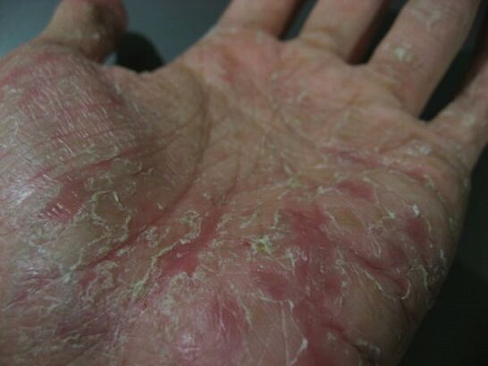 psoriasis on the palms of your hands