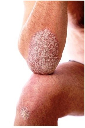 where there is psoriasis
