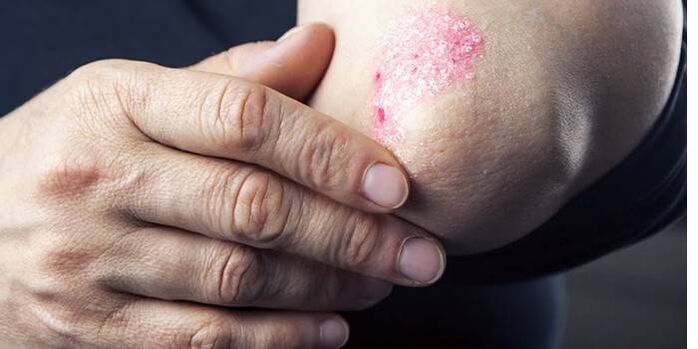 symptoms of psoriasis on the elbow