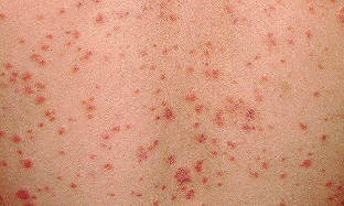 as it seems psoriasis early stage