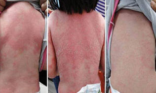 as it seems to psoriasis in children