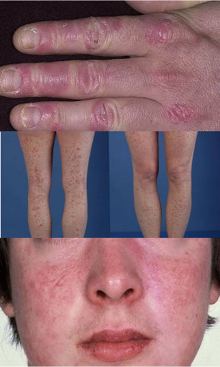 as it seems to psoriasis on face, hands and feet