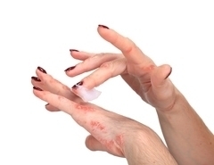 psoriasis on hands