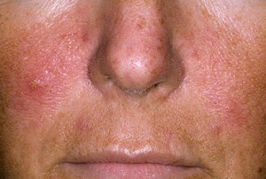 the symptoms of psoriasis on the face