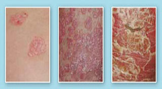 phase of psoriasis