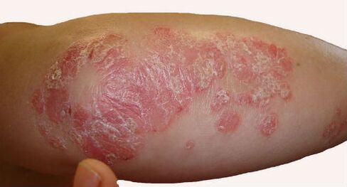 Large, scaly plaques on the elbows during exacerbations of psoriasis