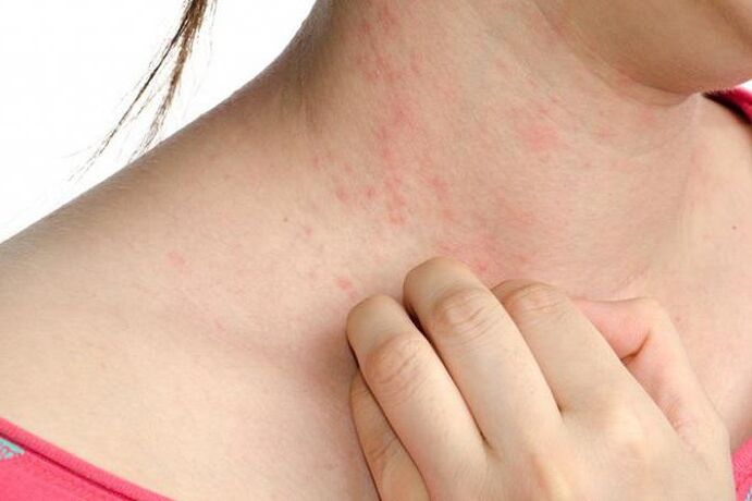 The severity of psoriasis is indicated by skin rashes and severe itching