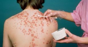 methods for the treatment of psoriasis