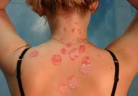 the treatment of psoriasis