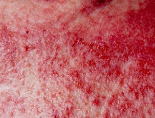 Advanced forms of psoriasis