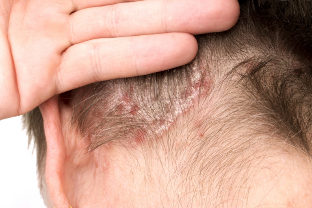 Deterioration of psoriasis on the head