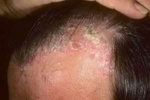 Posriasis on the scalp