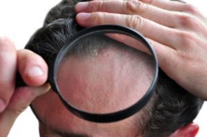Psoriasis on the head through a magnifying glass