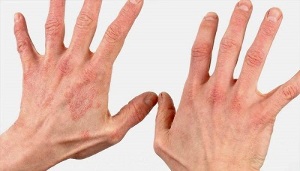 such as what are the early stages of psoriasis