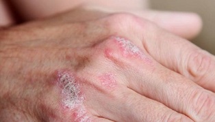 symptoms of early stages of psoriasis