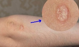 stage of development of psoriasis