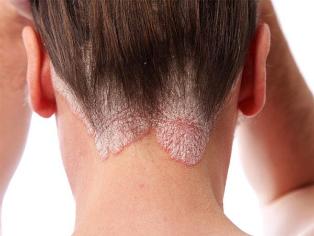 the treatment of psoriasis