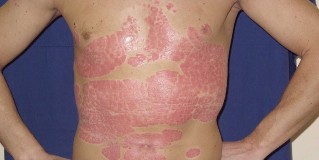 instructions for the integrated system for the treatment of psoriasis