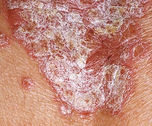 The level of psoriasis does not move