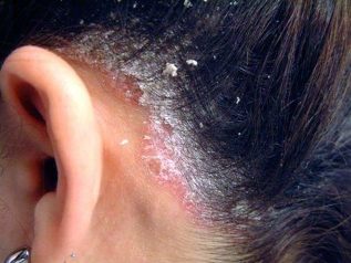 Psoriasis in the head