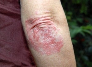 stage of development of psoriasis