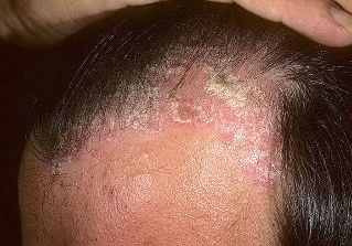 psoriasis in the head
