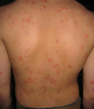 psoriasis in the back