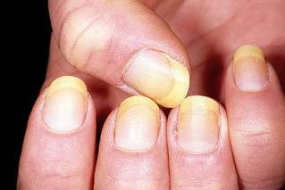 psoriasis nails
