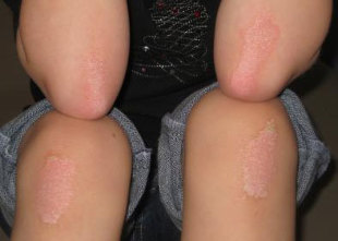 psoriasis on the elbows