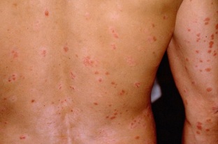 psoriasis early stage