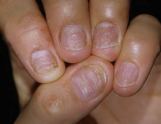 psoriasis-nails